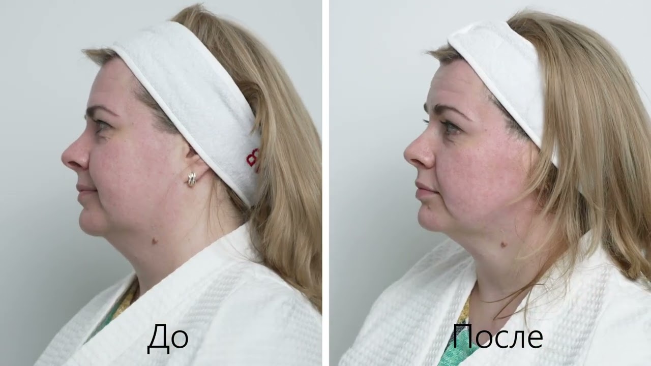 Новейший Ultraformer Mpt демонстрация процедур Mpt lifting Ultraformer и Mpt Toning Ultraformer