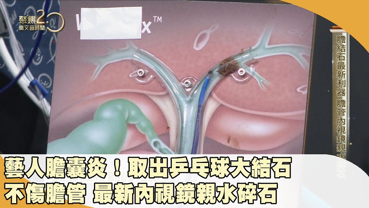藝人膽囊炎！ 取出乒乓球大結石　不傷膽管 最新內視鏡親水碎石 20230916【聚焦2.0】第506集