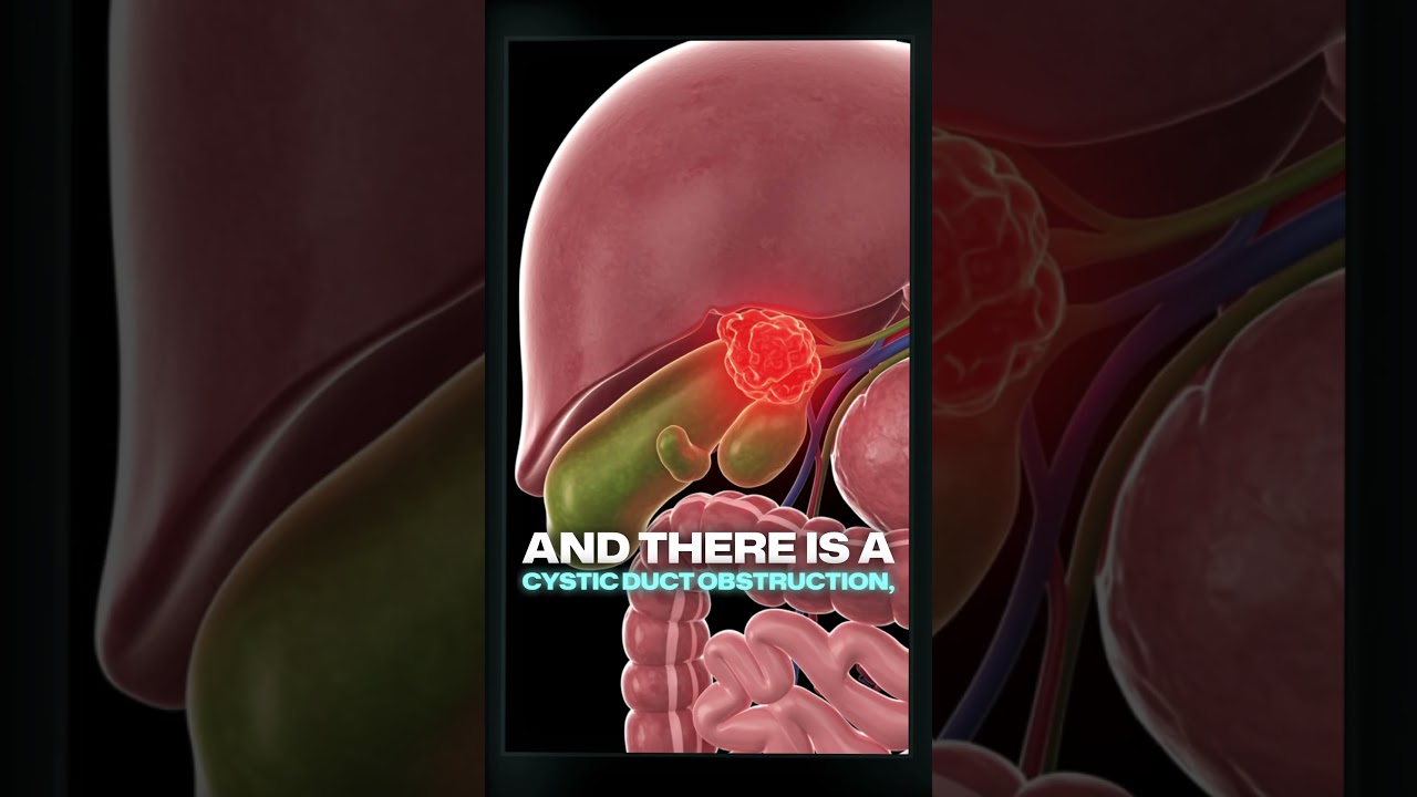 Understanding the HIDA Scan: Evaluating Gallbladder and Bile Duct Function #HIDA #biliarydyskinesia