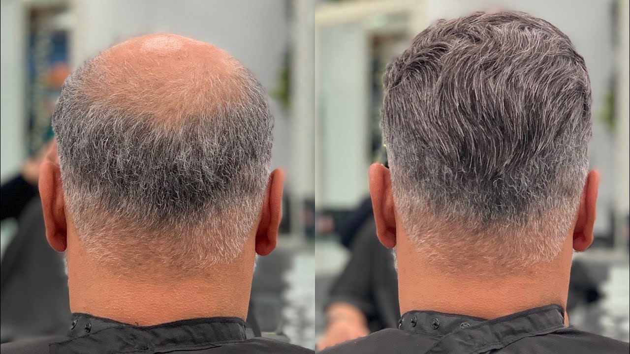 NON SURGICAL HAIR Replacement &ldquo;ARTEM | K Hair Salon&rdquo; Beverly Hills !