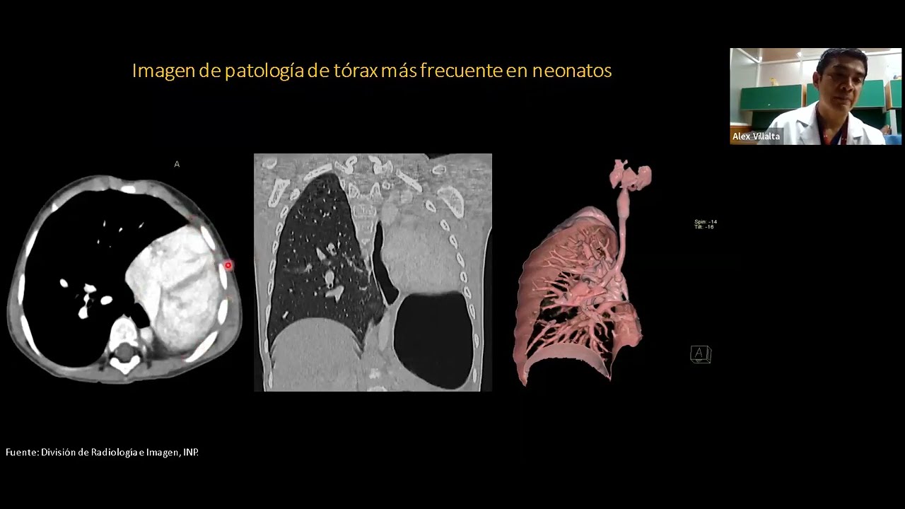 SESION - Abordaje radiol&oacute;gico de las Patolog&iacute;as Pulmonares m&aacute;s comunes en en Neonatolog&iacute;a.