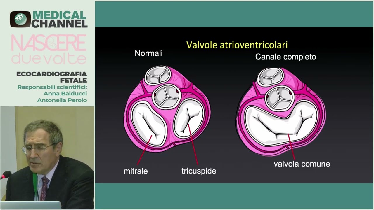 Il canale atrioventricolare - G. Pilu - A. Balducci