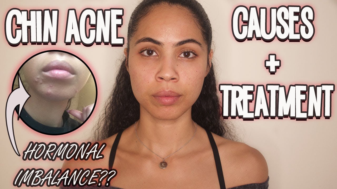 Chin Acne: Why You're Getting It & How To Prevent It Naturally