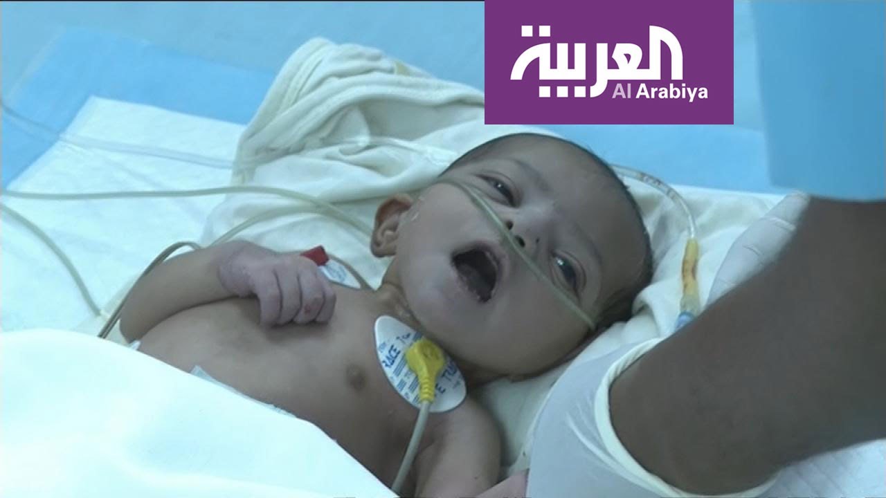 مركز الملك سلمان أجرى عمليات جراحية لـ 20 طفلا يمنيا من مرضى القلب