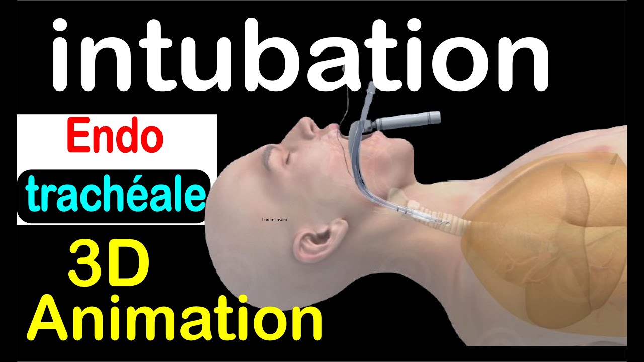 Réanimation : l'intubation endotrachéale 3D animation
