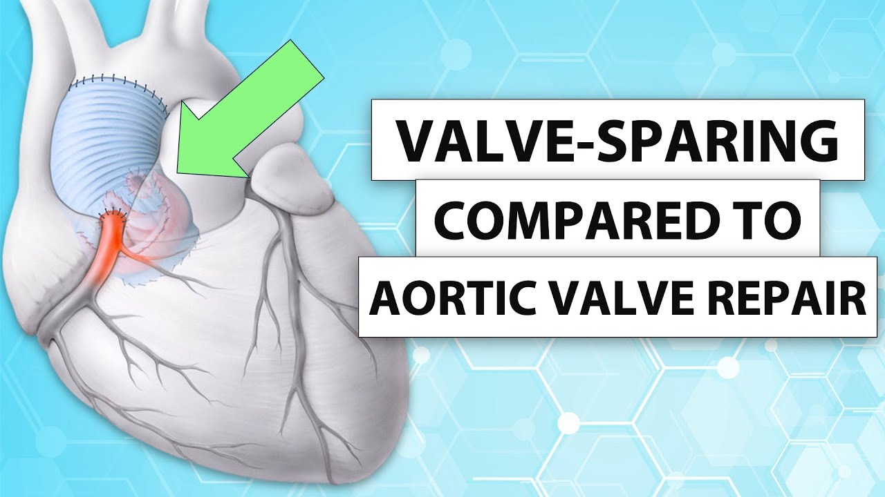 Surgeon Q&A: Is Bicuspid Valve-Sparing Aortic Root Replacement Similar to Aortic Valve Repair?