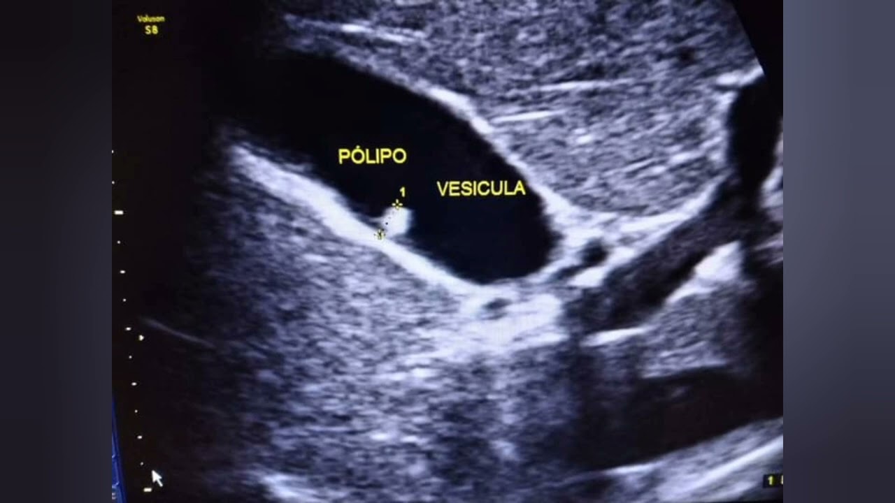 P&Oacute;LIPO VESICULAR CAUSAS S&Iacute;NTOMAS Y TRATAMIENTO