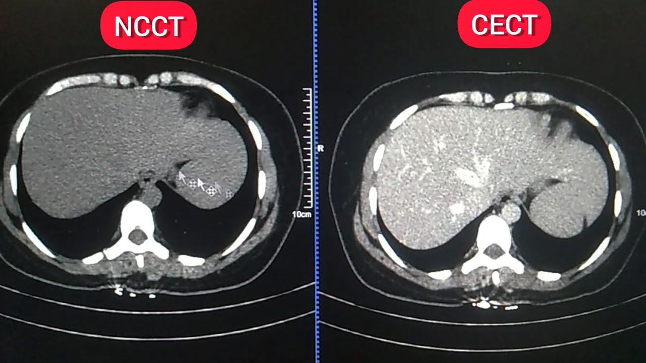 What's The Difference Ncct And Cect Whole Abdomen? |Difference Plane and Cect Abdomen l #CectAbdomen