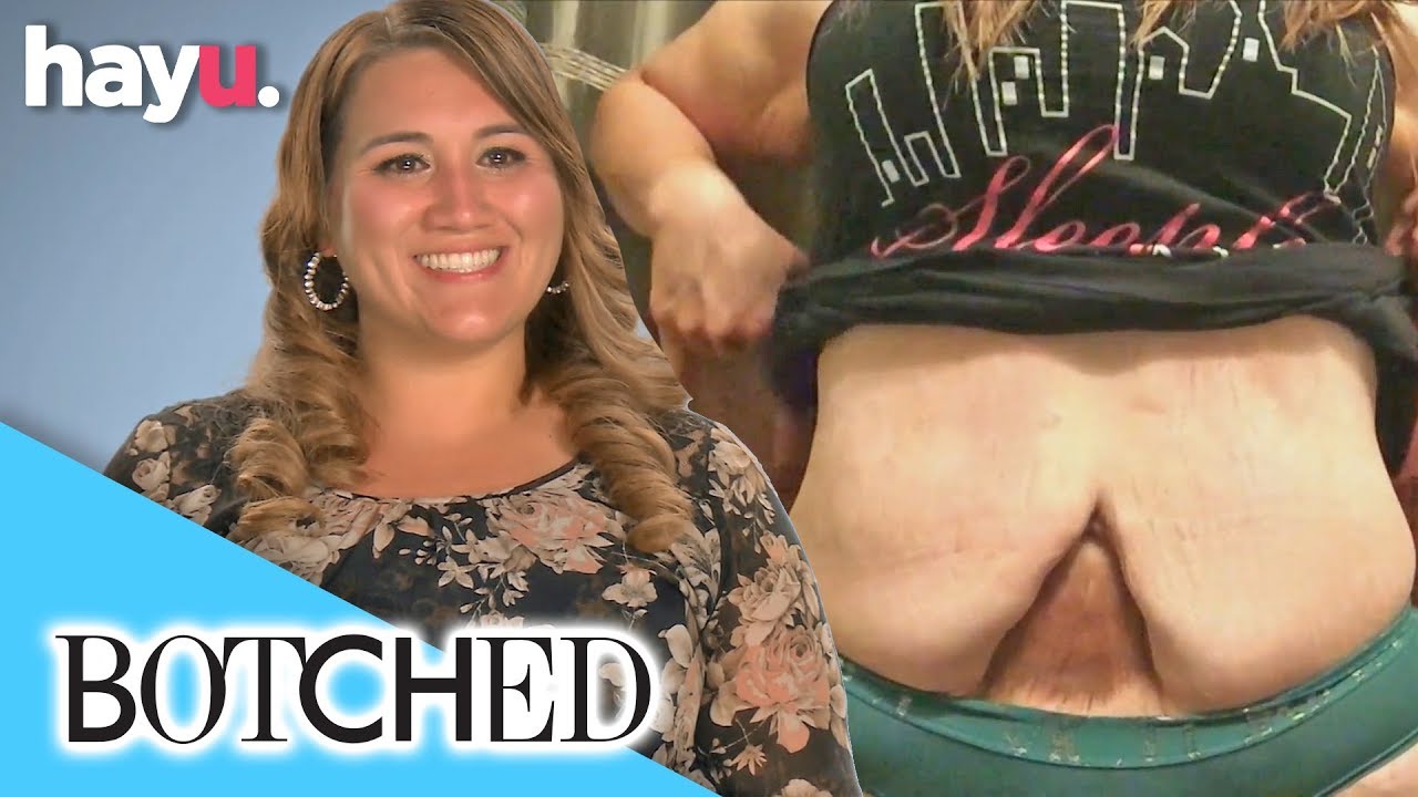 Woman Wants To Get Rid Of 'Christmas Tree Tummy' | Botched