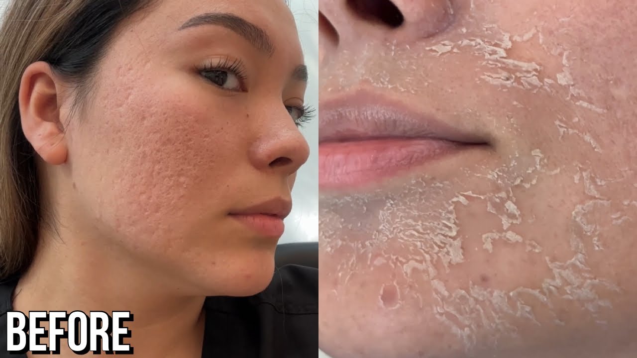 Chemical Peel Round 2! 1 Week Recovery