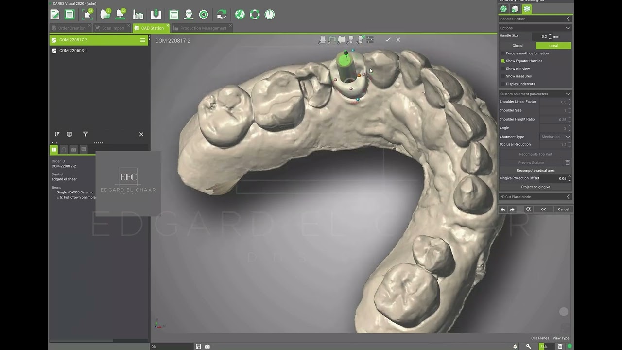 Digital Treatment planning Immediate Implant Placement-Co-Diagnostics and Synergy with Cares