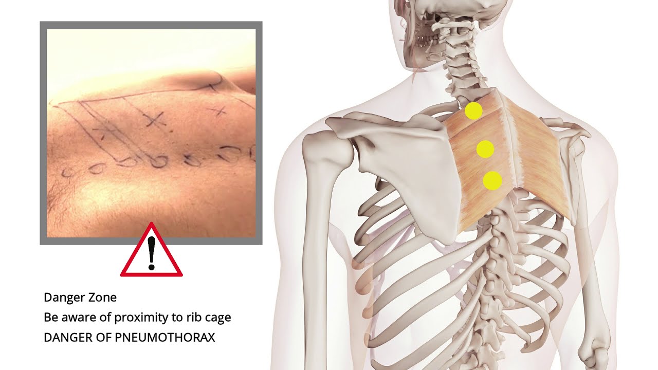 Trigger Point Release | Shoulder Pain | Rhomboids