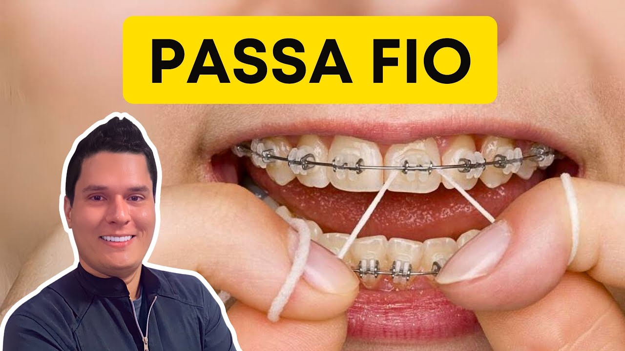 Passa Fio Ortodôntico : Como usar do Jeito Certo?