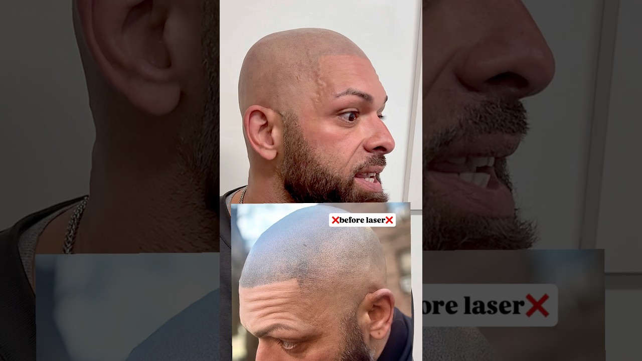 What are the disadvantages of                Scalp Micropigmentation !