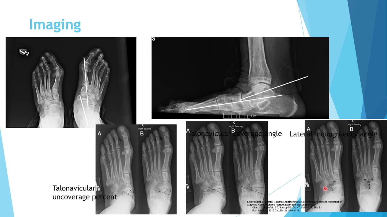 Foot and ankle 1:PTTD (posterior tibial tendon dysfunction) AAFD (adult acquired flatfoot deformity)