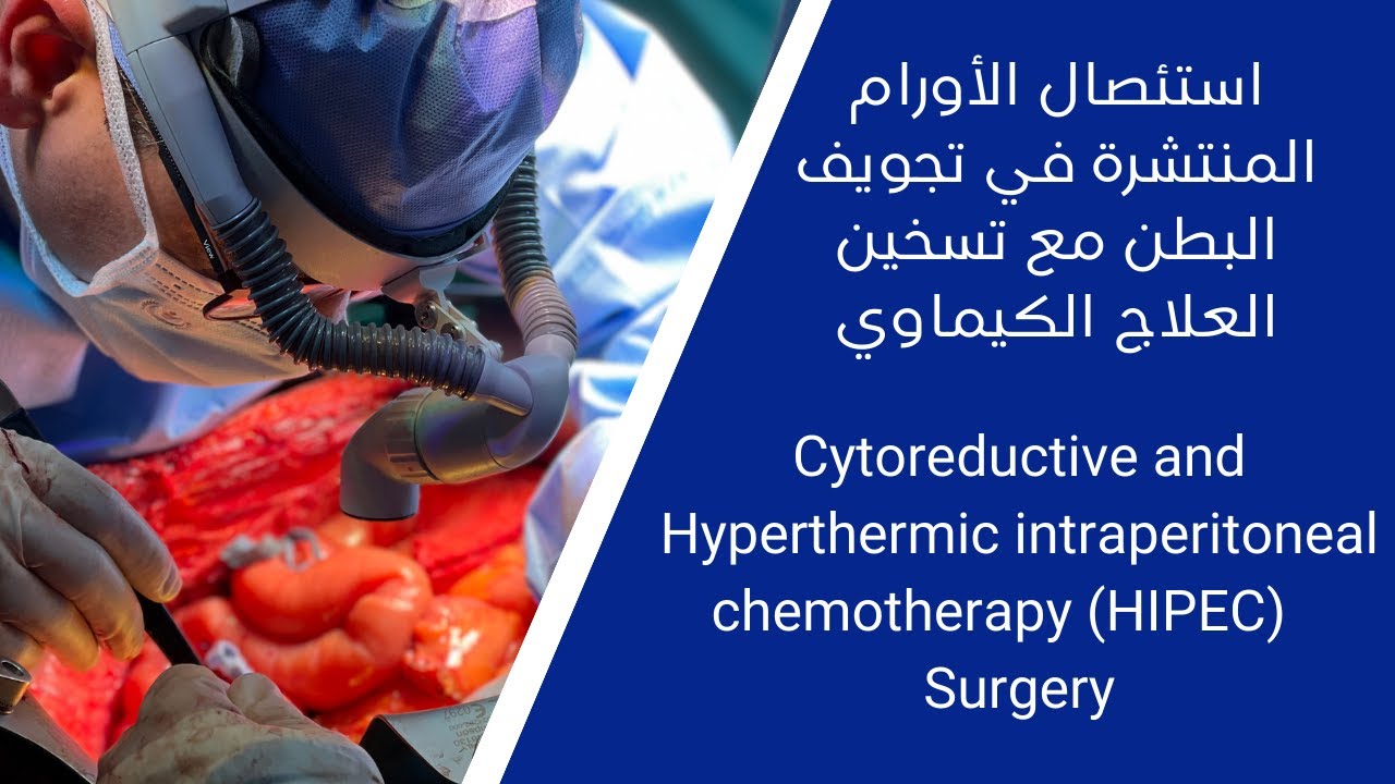 أورام القولون المنتشرة في تجويف البطن الاستئصال مع تسخين الكيماوي I Cytoreductive and HIPEC Surgery
