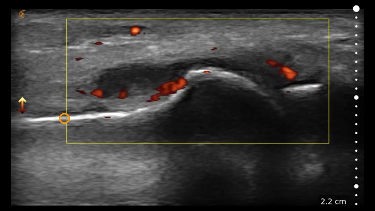 Image Interpretation: 1st Metatarso-phalangeal (MTP)
