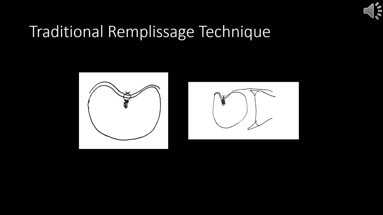 Arthroscopic Double Pulley Remplissage Technique