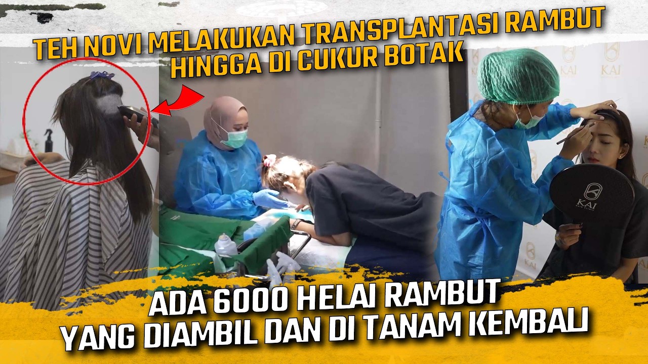 TEH NOVI MELAKUKAN TRANSPLANTASI RAMBUT SAMPAI DICUKUR BOTAK DEMI BISA DI AMBIL 6000 HELAI RAMBUTNYA