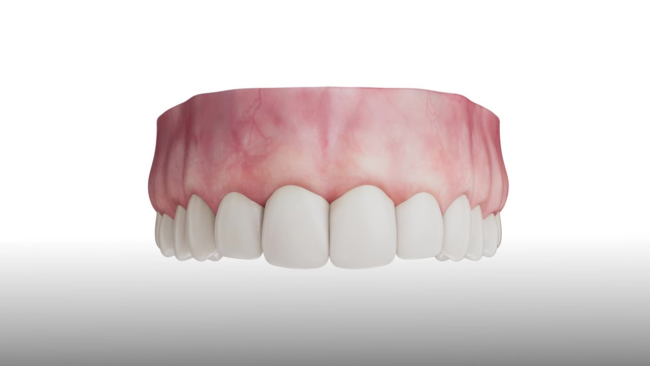 Oral Surgery - Alveolar Ridge Expansion