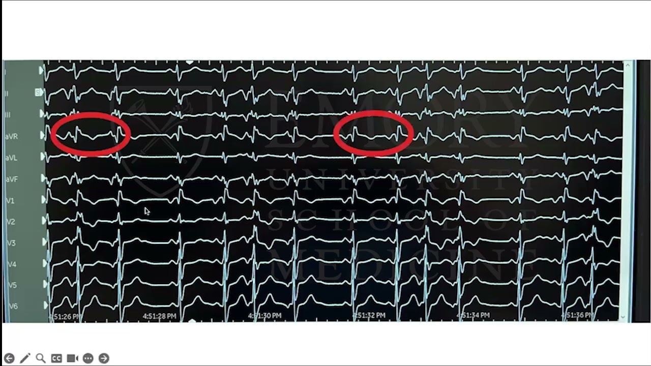 Mitral Annular Disjunction and Arrhythmias