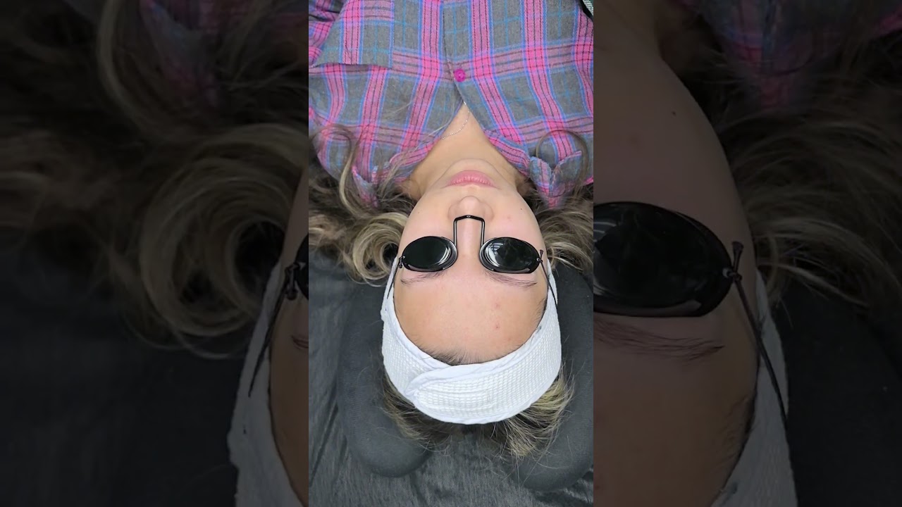 Чистка лица! готова представить лазер (на Алтае такого нет!)👌Результаты просто 💥