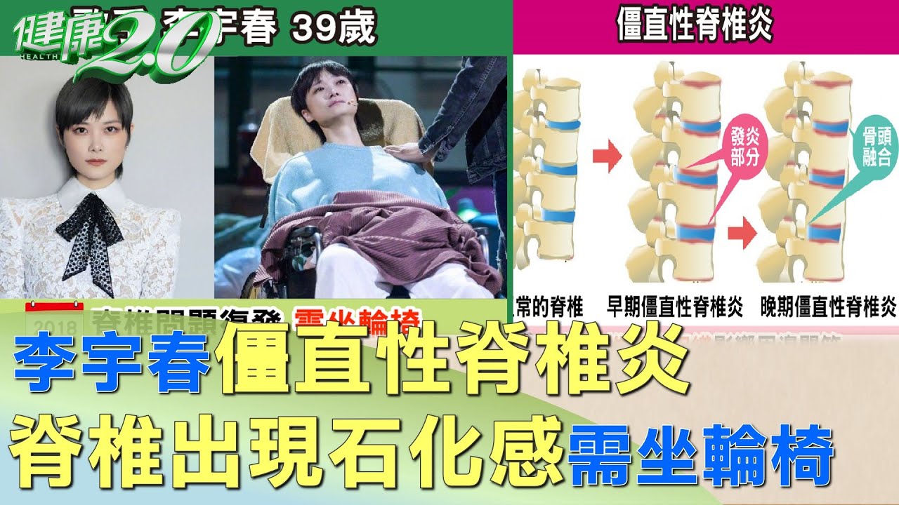 李宇春僵直性脊椎炎 脊椎出現石化感需坐輪椅 健康2.0