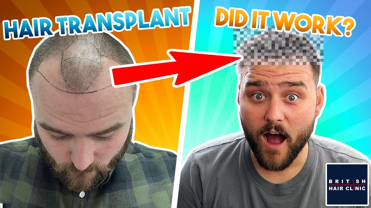 Do Hair Transplants Work? *NINE MONTH UPDATE*