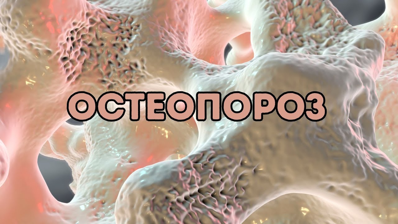 Остеопороз: міфи та правда #остеопороз