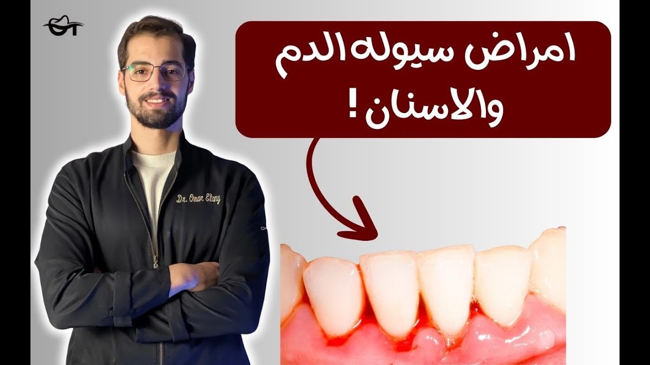 تأثير امراض سيوله الدم على صحه الفم والاسنان | اهم التعليمات قبل زياره طبيب الاسنان