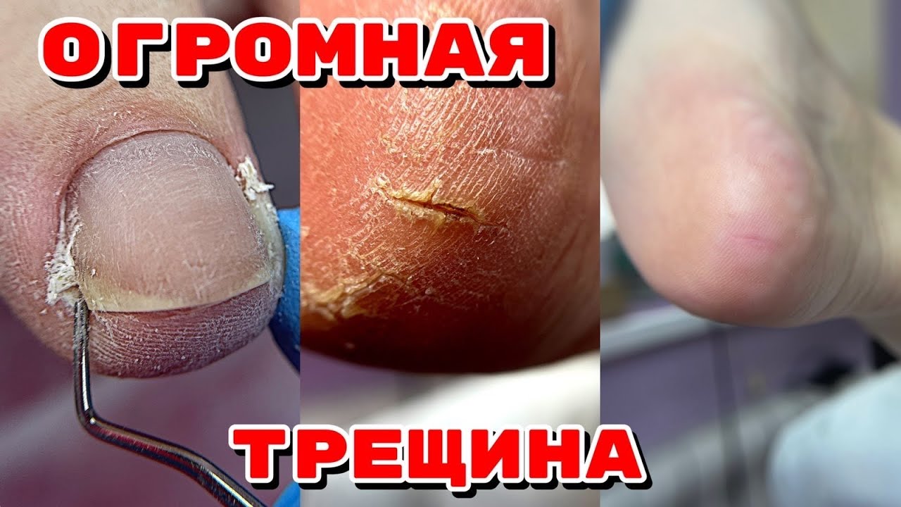 ТРЕЩИНА НА ПЯТКЕ 😥 Огромная подногтевая мозоль 🦶 Педикюр после зимы