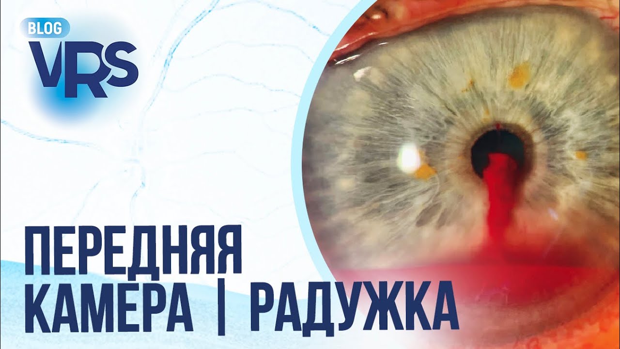 Травма глаза / Передняя камера и радужка