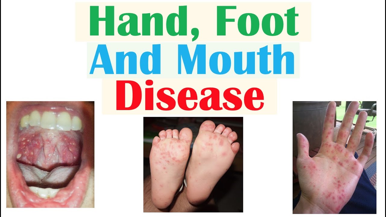 Hand, Foot and Mouth Disease | Viruses, Pathophysiology, Signs and Symptoms, Diagnosis, Treatment