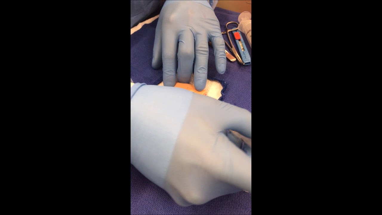 Field Block w/ Abscess I&D