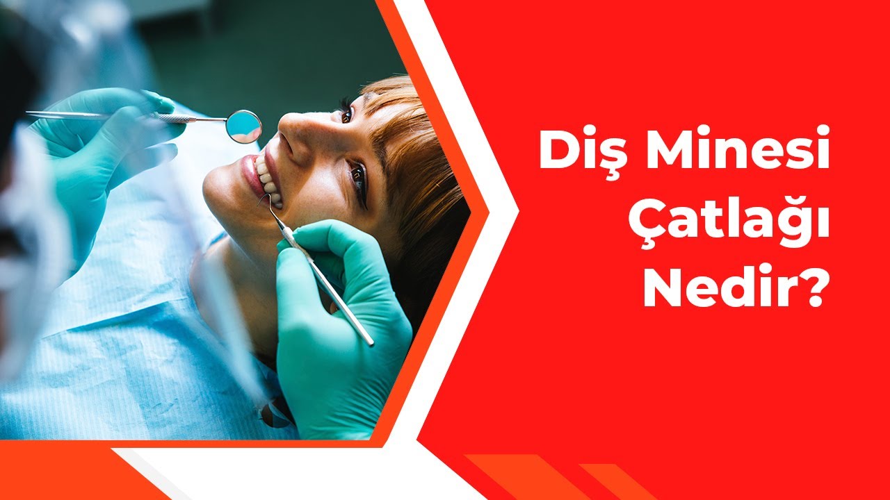 Diş Minesi Çatlağı Nedir?