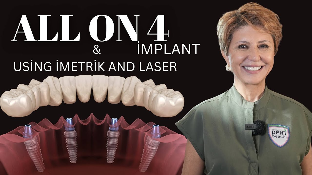 All on 4 & All on 6 Implants | The Future of Digital Dentistry at Dent Beauté 🦷✨