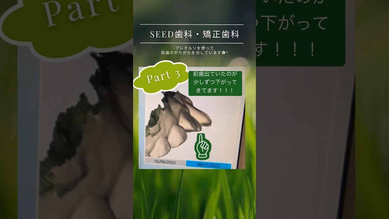 プレオルソを使って歯が動いたシリーズ！！Part 3です🩷🩷前歯が出ていたのが下がったのわかりますか？？ #審美歯科 #アメリカ留学 #歯科留学 #マウスピース矯正 #部分矯正