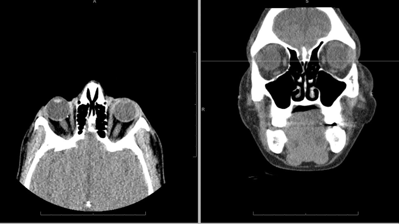 CT (computed tomography) face radiology search pattern