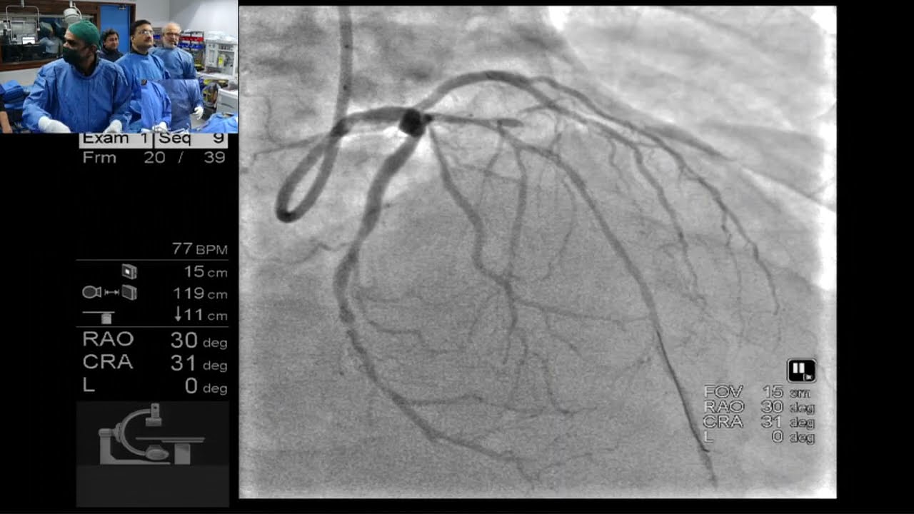 PCI of diffusely diseased small-caliber tortuous LAD by Tejas Patel and Sanjay Shah