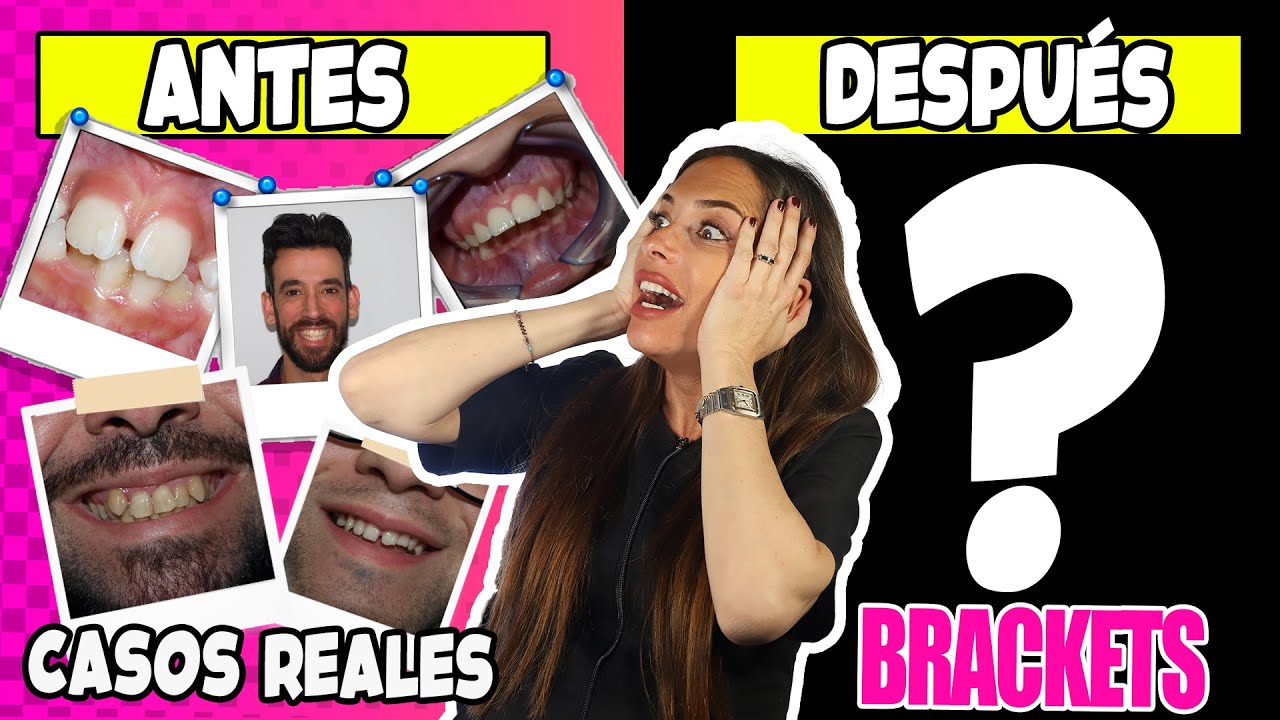 🙋‍♂️ Personas 𝐀𝐧𝐭𝐞𝐬 𝐲 𝐃𝐞𝐩𝐮é𝐬 de los 𝗕𝗥𝗔𝗖𝗞𝗘𝗧𝗦 fotos ¡5 CAMBIOS EXTREMOS de Ortodoncia SORPRENDENTES!