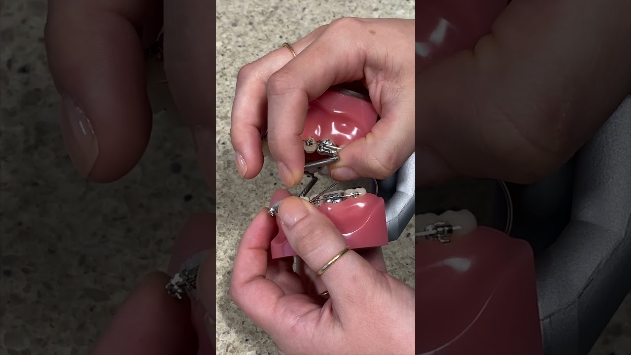 How to fix your Forsus Springs