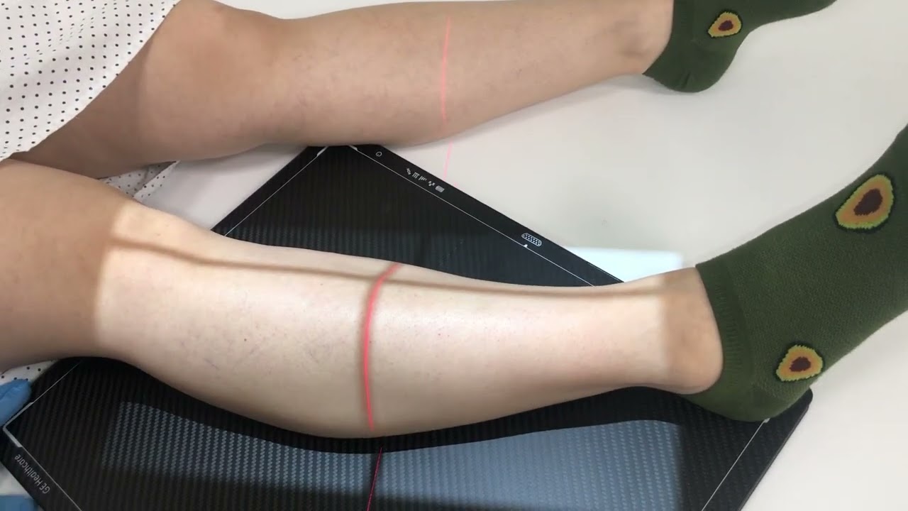 RX TIBIA 2P