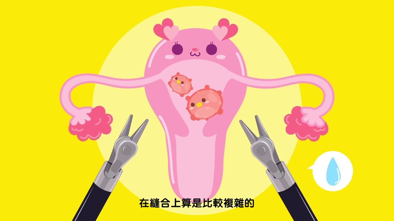 【問8小劇場】達文西手術介紹