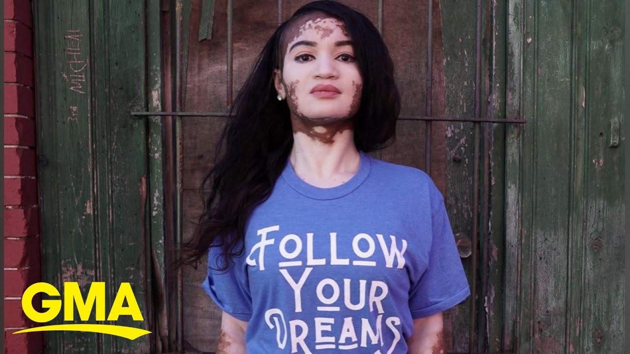 She used to spray tan to cover her vitiligo, now she’ll never hide her true beauty l GMA Digital