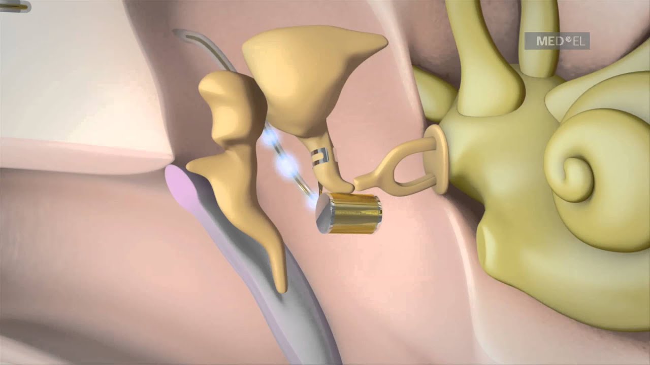 VIBRANT SOUNDBRIDGE Mittelohr Implantat System für Patienten mit Hörverlust | MED-EL