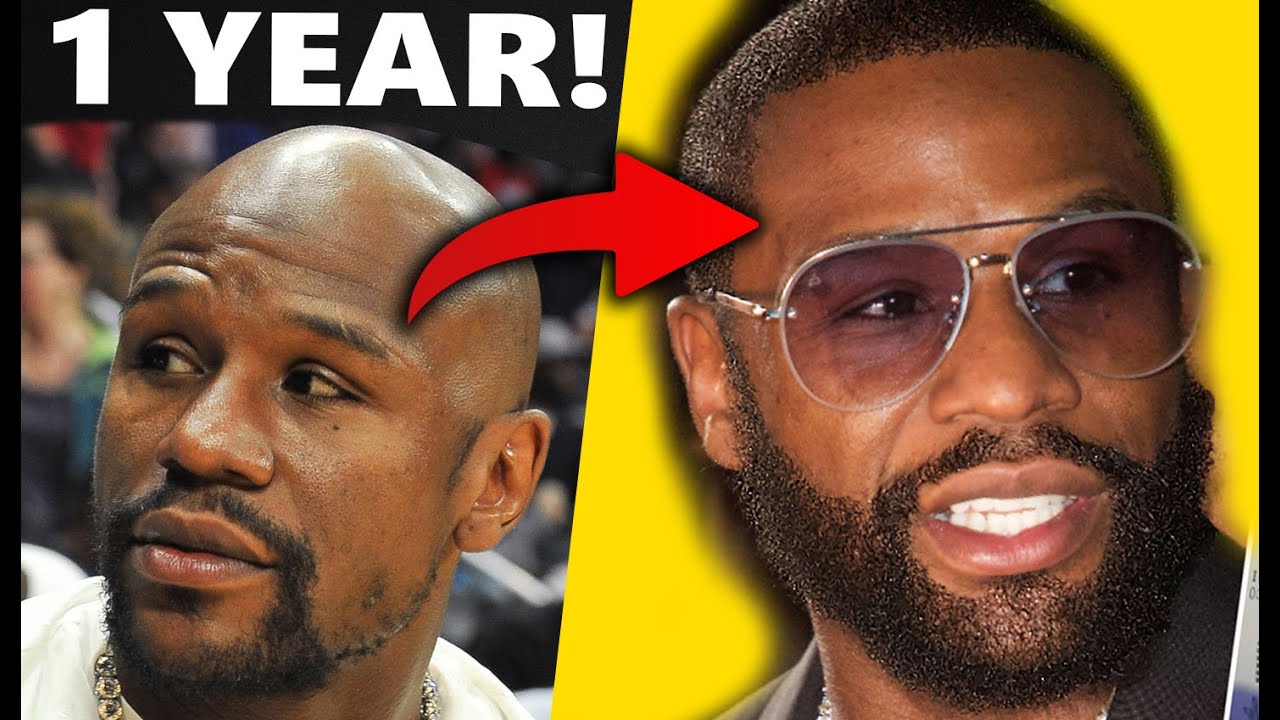 Floyd Mayweather's INSANE Results!!! Beard and Hair Transplant 1+ Year After