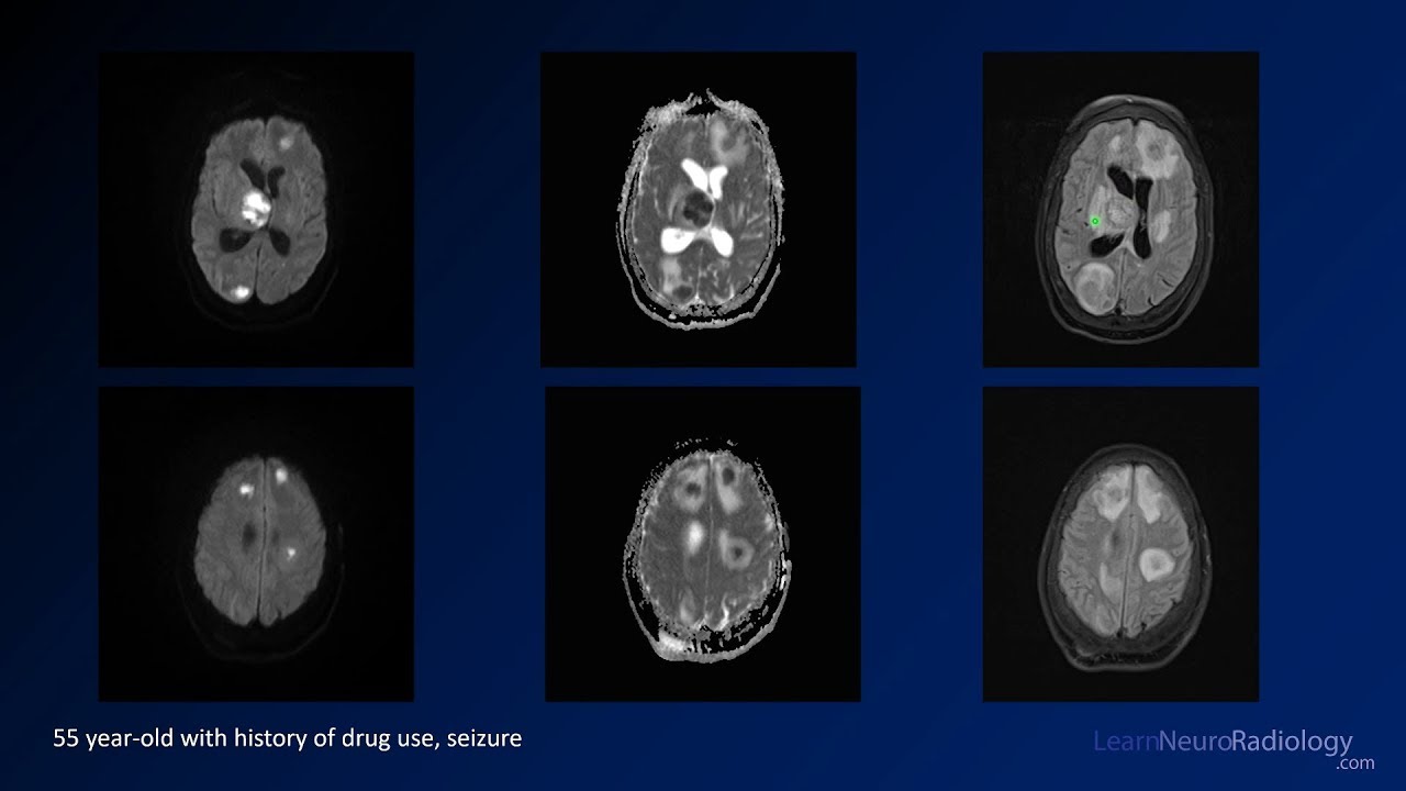 Intracranial infections - 3 - Focal Infections