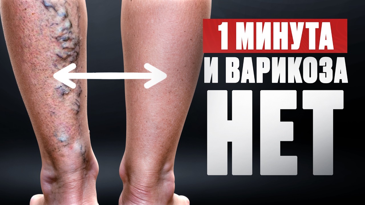 Всего 1 упражнение уничтожит ВАРИКОЗ раз и навсегда!