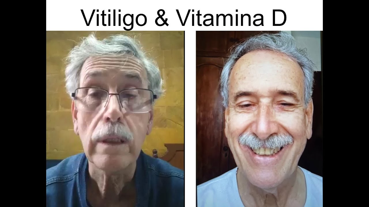 Luiz - Vitiligo #827