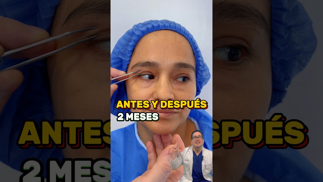 Antes y despu&eacute;s de 2 Meses de Blefaroplastia Superior e Inferior Transconjuntival #blefaroplastia